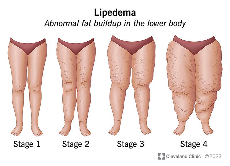 What are the Stages of Lipedema?